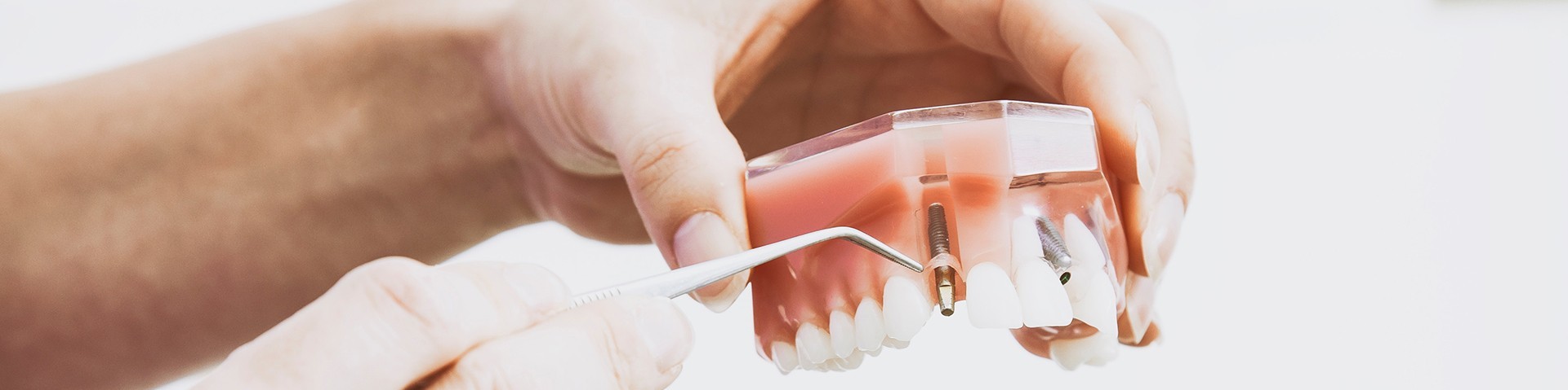 Implantologie au cabinet dentaire du Dr Lavigne à Hyères