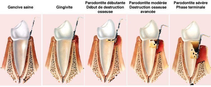 Parodontite et problèmes de gencive